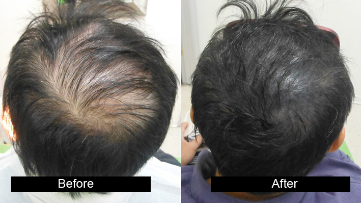 Biostimulated FUE by Dr amanpreet Singh in AG Clinics