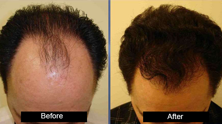 Biostimulated FUE by Dr amanpreet Singh in AG Clinics